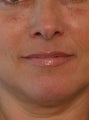 Juvederm
