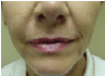 juvederm