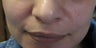 Juvederm