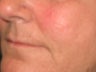 Juvederm Ultra