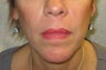 Juvederm for lines around the mouth
