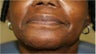 Lip augmentation with Juvederm