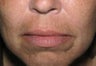 Juvederm