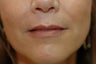 Juvederm