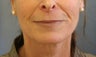 Juvederm injection