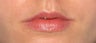 Juvederm in the Lips