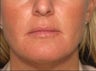 Juvederm in the Lips