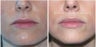 Juvederm: Subtle Lip Enhancement