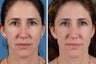 Juvederm Ultra, Restylane & Dysport