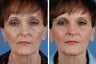 Juvederm Plus