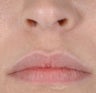 Lip Injection