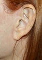 Earlobe filler