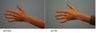 Juvederm to hands