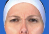 Juvederm