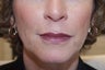 Juvederm