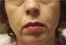 Juvederm