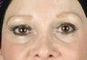 under eye fillers
