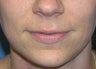 Juvederm Lip Enhancement