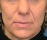 Volume Filler to Nasolabial Folds and Eye region