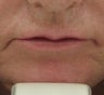 63 year old lip Augmentation with Juvederm
