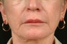 Juvederm Injectable Filler