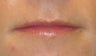 Juvederm