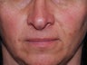 Juvederm