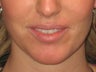 Juvederm