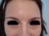 Under Eye Filler Treatment