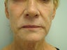 Facelift In A Syringe