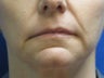 Juvederm chin and lip enhancement