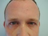 Undereye Filler
