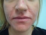 Lip Filler Injection