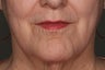 Juvederm Lip Enhancement