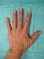 Filler & IPL Before