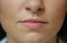 Juvederm Lip Augmentation