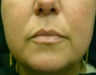 Juvederm Lip Augmentation