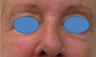 Juvederm Filler for lower eyelid hollows
