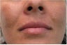 Juvederm for upper lip and nasolabial folds