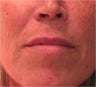 Juvederm to the upper lip