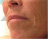 Juvederm to Upper Lip
