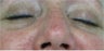 Juvederm for lower eyelid hollows