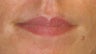 Juvederm Lip Augmentation
