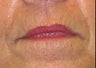 Juvederm effacement of perioral lines