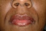 Juvederm