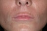 Juvederm Ultra