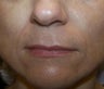 Juvederm