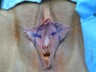 Labia Reduction Surgery
