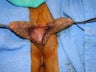 Labia Reduction Surgery
