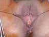 Labia Reduction Surgery (Labiaplasty)